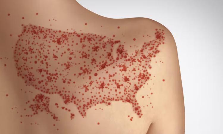 An image of a person's shoulder with red spots in the rough shape of the United States. (wildpixel/iStock/Getty Images Plus via The Conversation)
